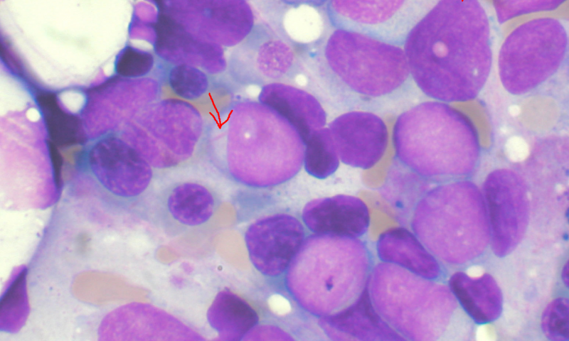 Study leads to breakthrough in better understanding acute myeloid leukemia